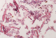 ब्लैक फंगस- महामारी के बाद एक नई आपदा के संकेत Black fungus - signs of a new disaster after the epidemic