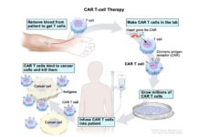 कार-टी सेल तकनीक से जगी कैंसर उपचार की उम्मीद CAR-T cell technology gives hope for cancer treatment