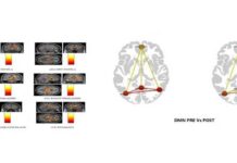 अल्जाइमर के इलाज में प्रभावी हो सकता है मेडिटेशन Meditation may be effective in treating Alzheimer's