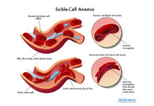 सिकल सेल एनीमिया के उपचार के लिए हाइड्रोऑक्सीरिया को मंजूरी Hydroxyurea approved for treatment of sickle cell anemia